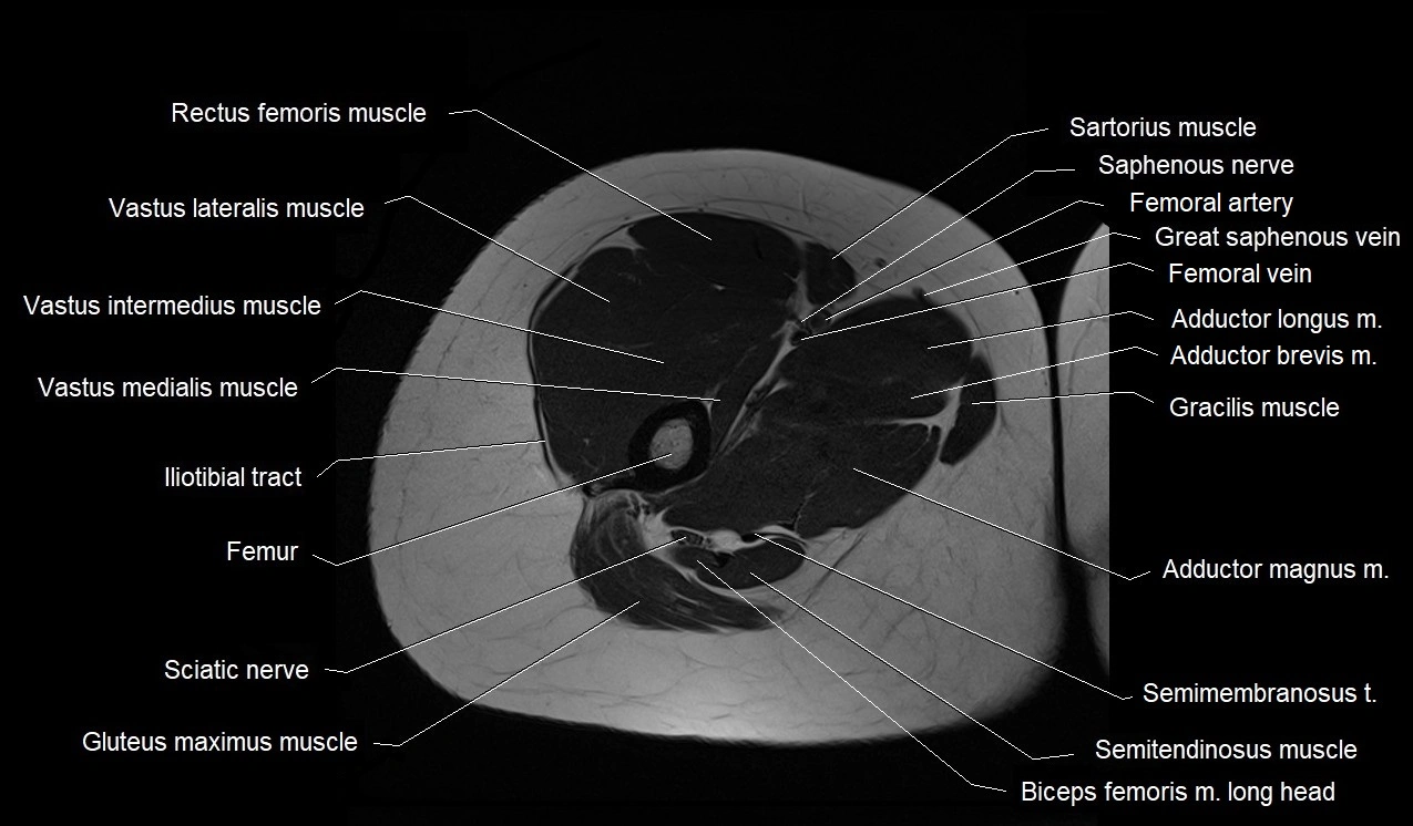 MRI thigh cross sectional anatomy image 19.webp